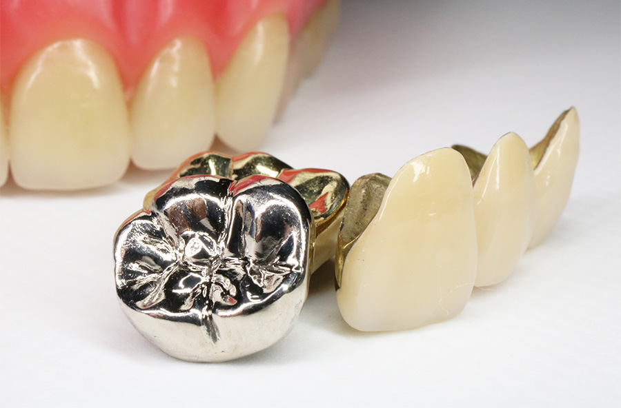 審美治療のメリットとは？02_金属アレルギーのリスクを軽減