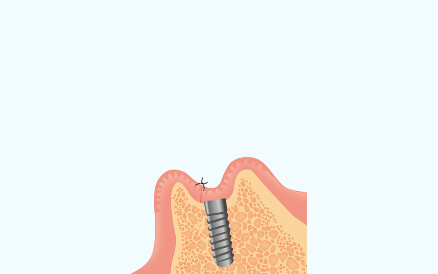 インプラント治療の流れ03_インプラント体の埋入手術