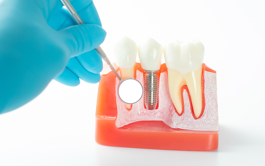インプラント治療の流れ07_メンテナンス