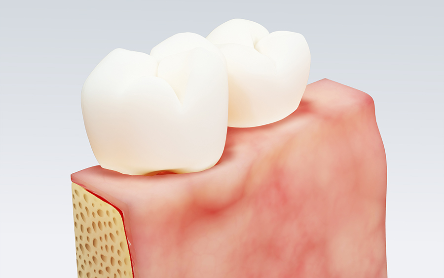 なぜメンテナンスが大切なのか01_インプラント周囲炎を防ぐ
