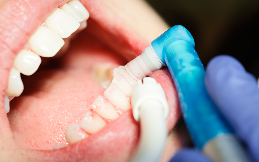 定期検診で予防歯科を03_歯のクリーニングやフッ素塗布、ブラッシング指導をします。